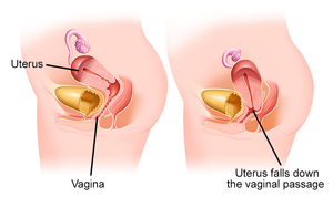 Navigating Menstrual Cup Use with Pelvic Organ Prolapse: What You Need to Know